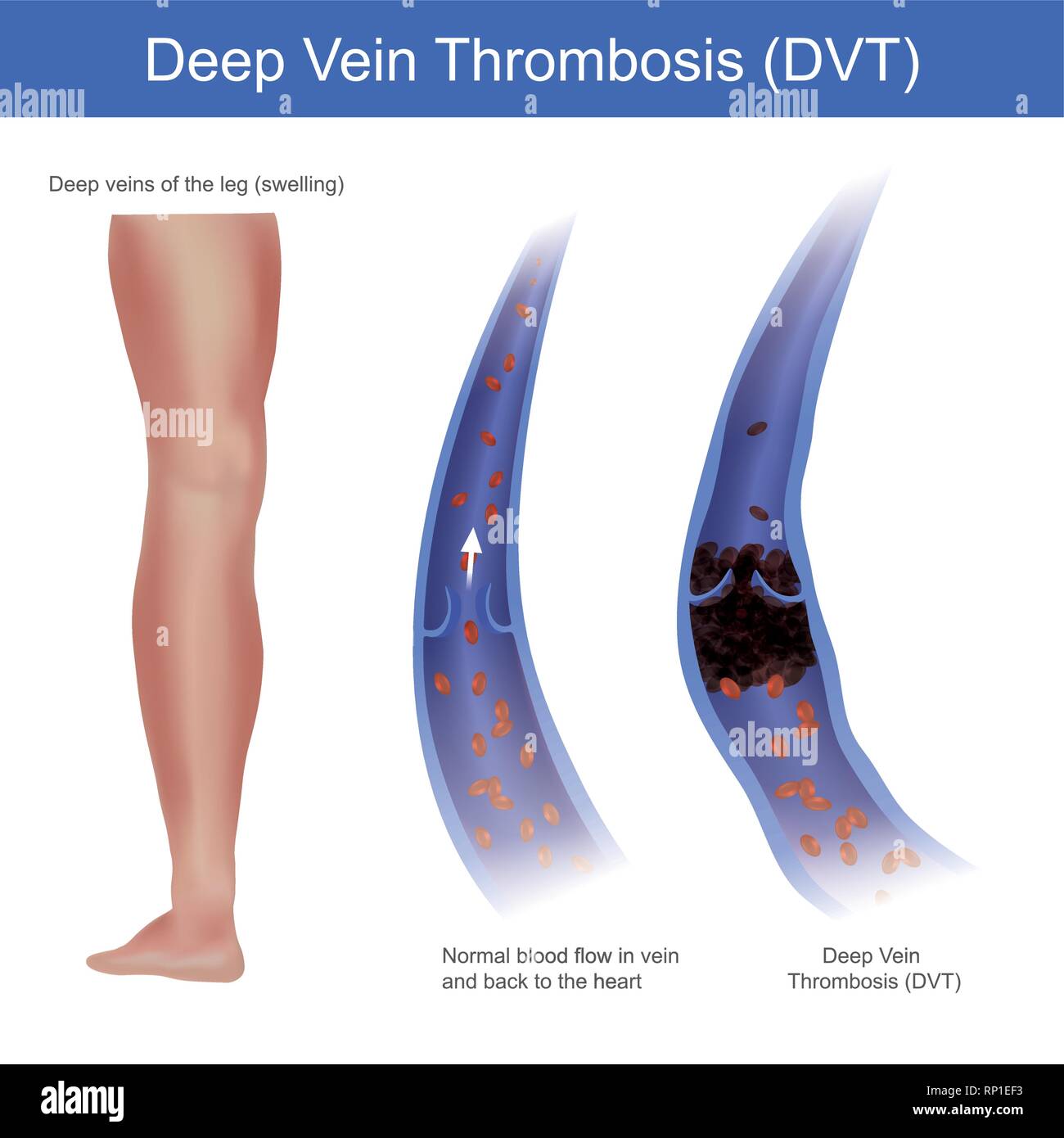 In normal conditions red blood cell flow in vein and back to the heart, but the Deep Vein Thrombosis symptoms (DVT) red blood cell will flow through Stock Vector
