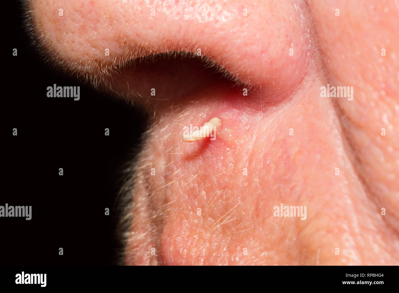 Sebaceous gland hi-res stock photography and images - Alamy
