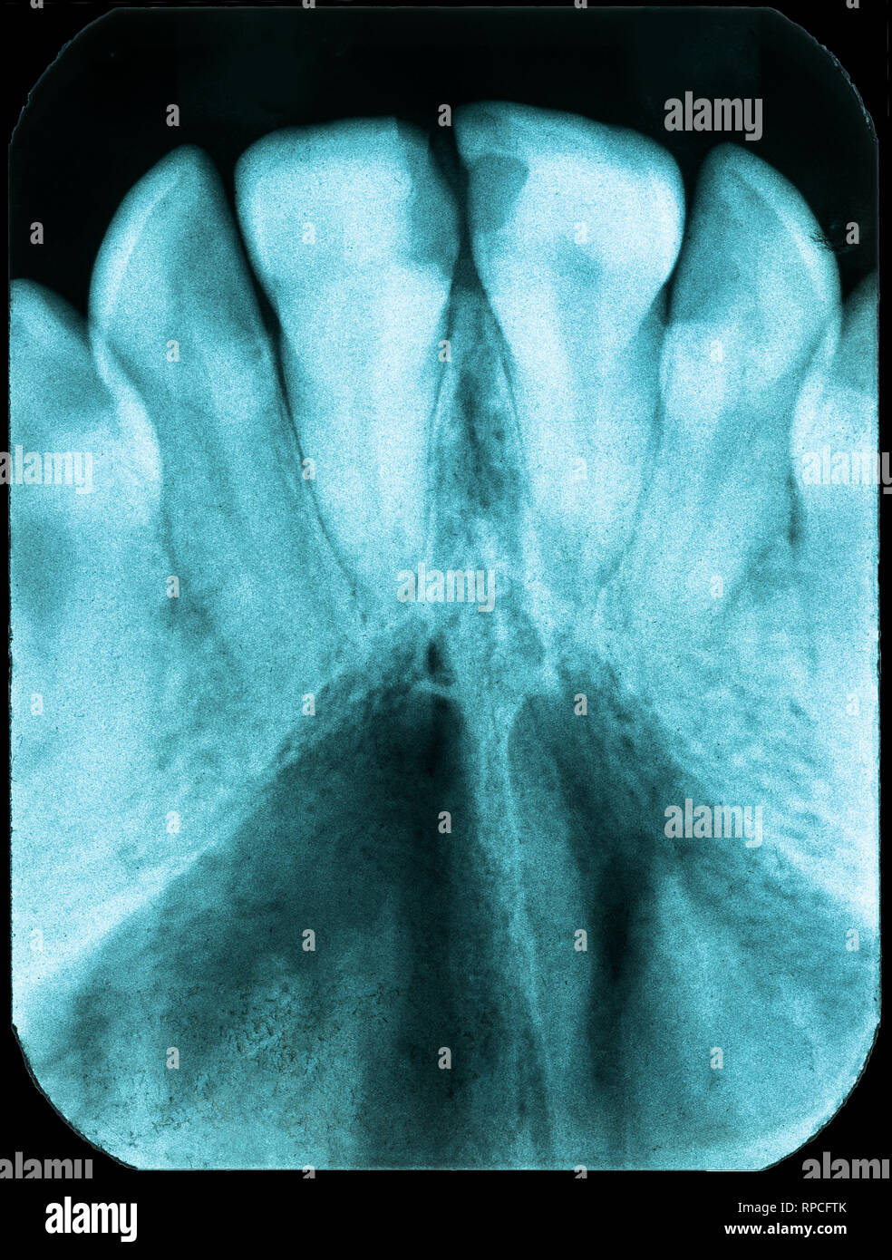 Old Dental x-ray with teeth in bad condition Stock Photo