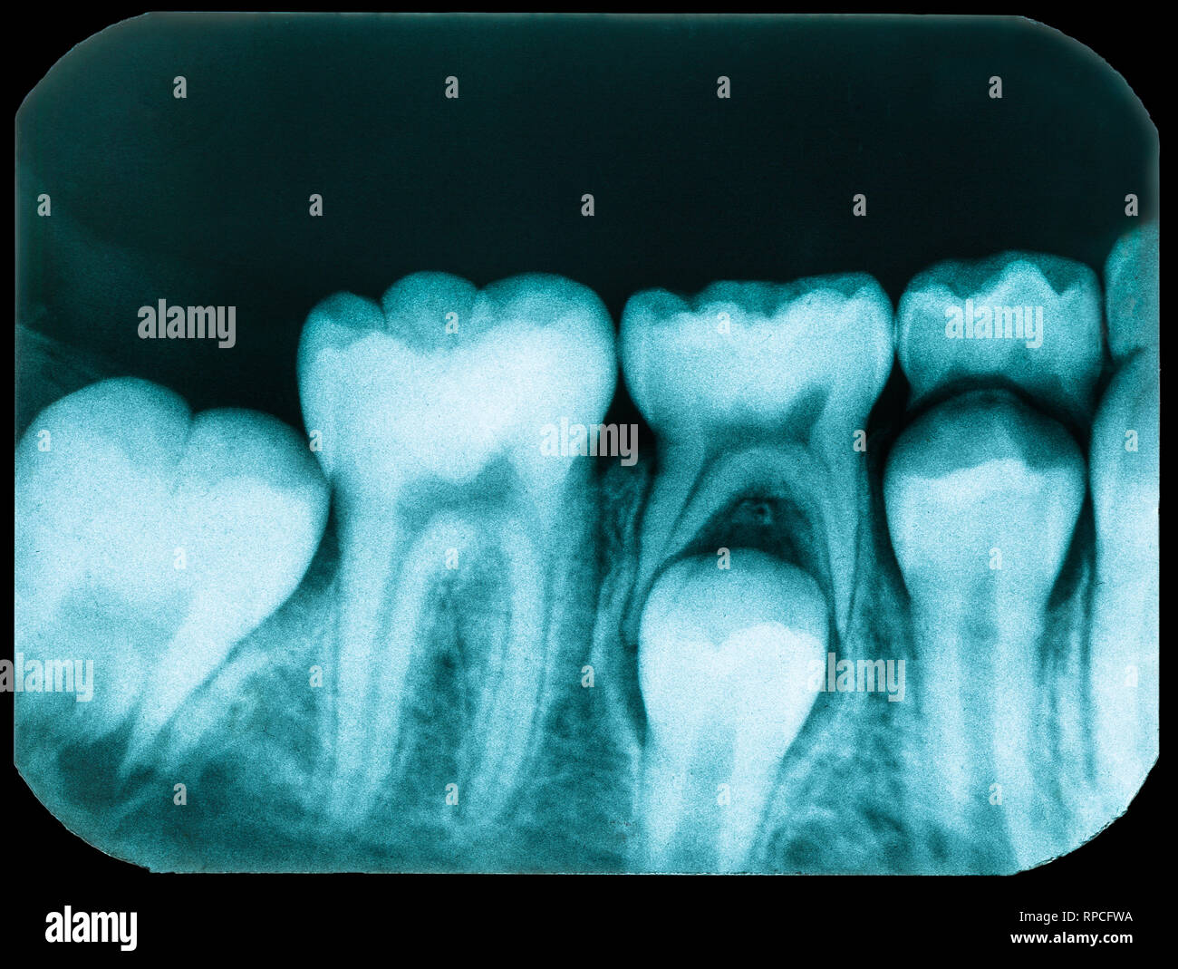 Old Dental x-ray with teeth in bad condition Stock Photo