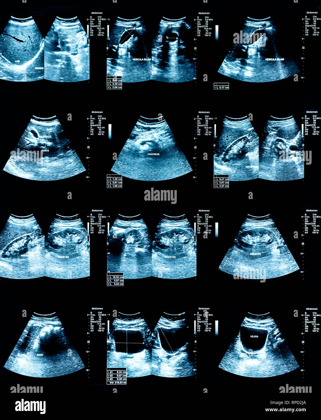 Echography Image (Ultrasound) of abdomen Stock Photo