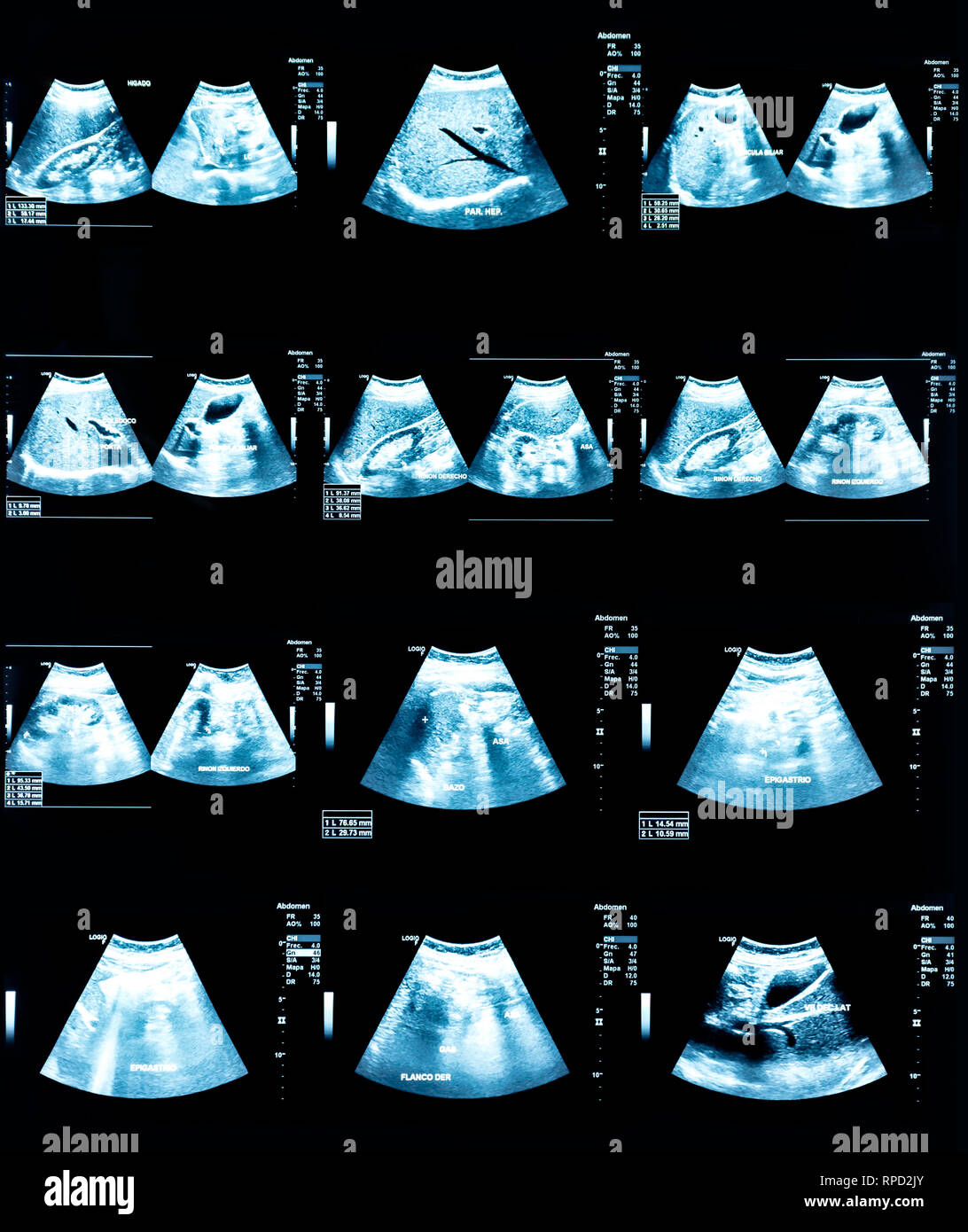 Echography Image (Ultrasound) of abdomen Stock Photo