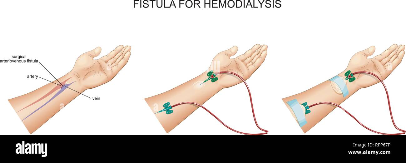 vector illustration of intravenous catheter, hemodialysis and fistula Stock Vector