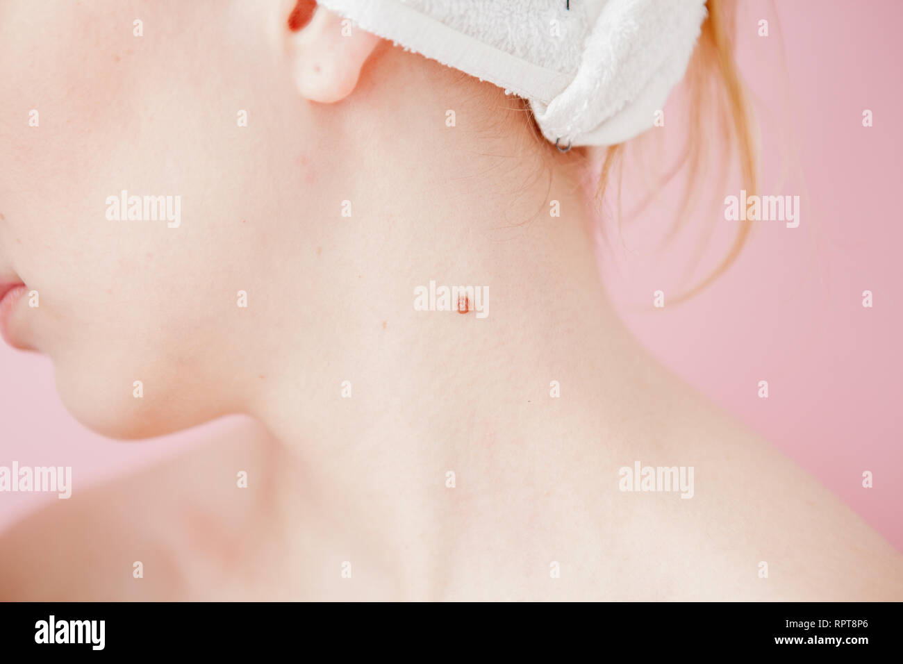 Close Up View On The Back Of A Female Neck On A Woman With Her Hair Tied Up To Reveal Three Moles With One Large One Under Her Hair Line Stock Photo Close Up View On The Back Of A Female Neck On A Woman With Her Hair Tied Up To Reveal Three Moles With One Large One Under Her Hair Line Stock Photo