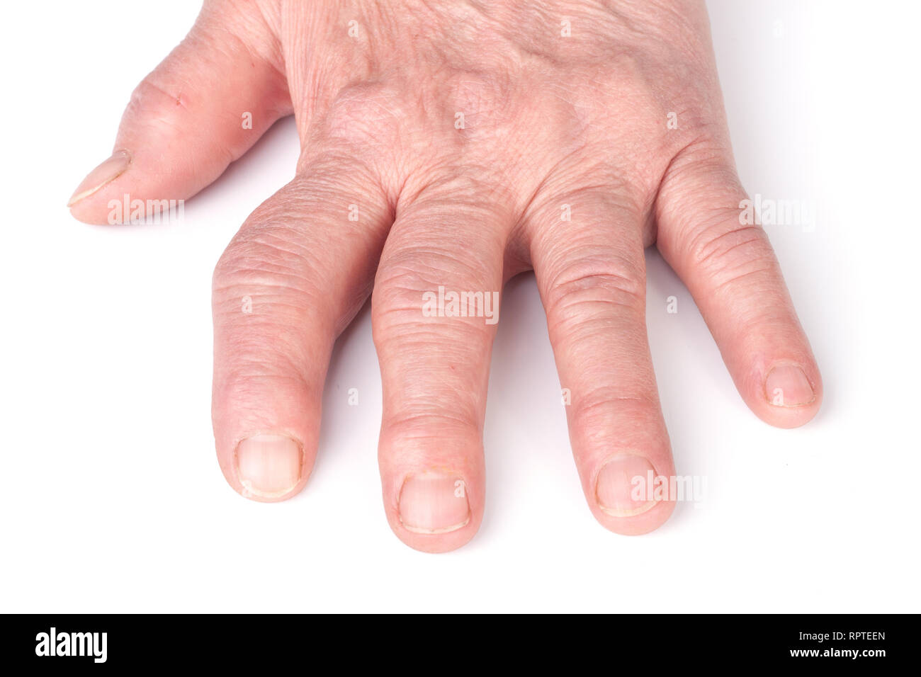 Rheumatoid polyarthritis of hands isolated on white background Stock Photo