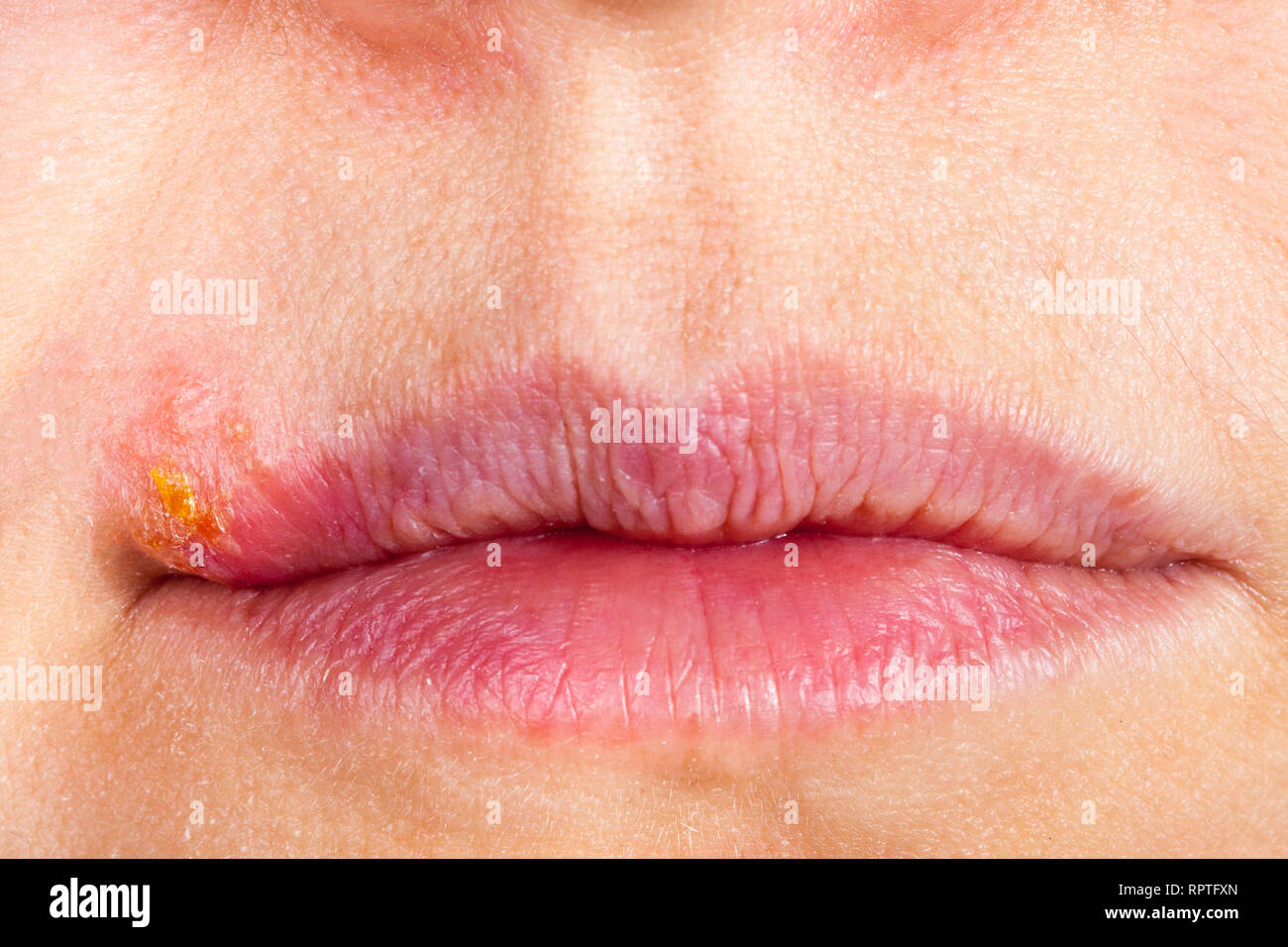 Herpes on lip hires stock photography and images Alamy