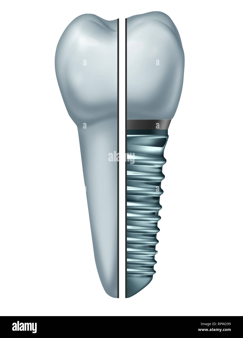Dental Implant tooth or endosseous tooth prosthetic comparison with an orthodontic crown abutement and metal screw isolated on a white background. Stock Photo