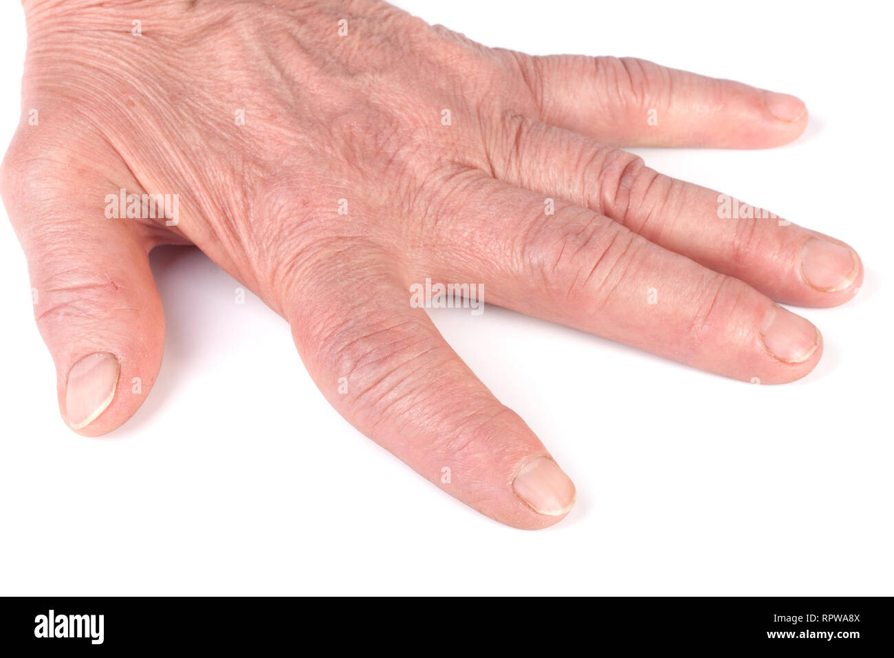 Rheumatoid polyarthritis of hands isolated on white background Stock Photo