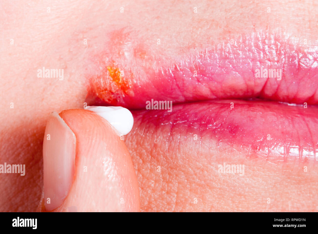 Herpes on the lip close-up macro. Woman lubricates the labial herpes ointment Stock Photo