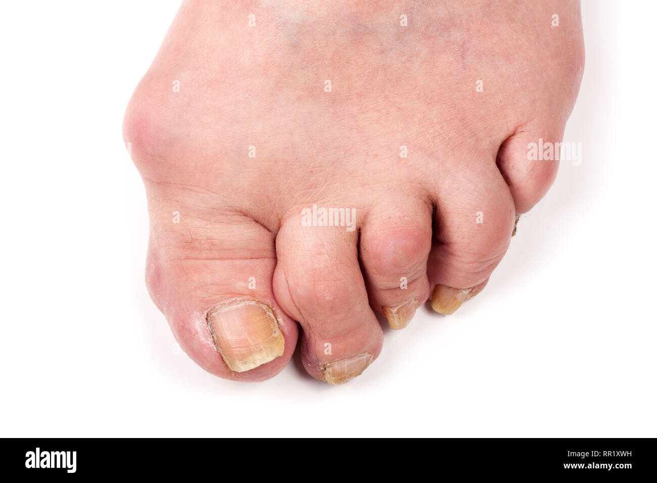 Rheumatoid polyarthritis on foot isolated on white background Stock Photo