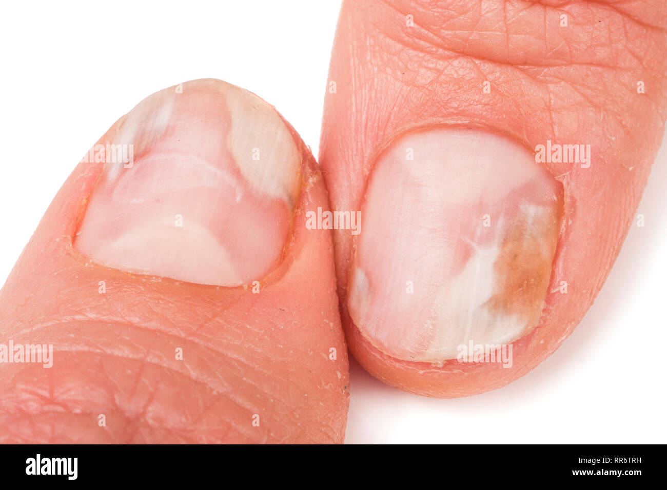 two fingers of the hand with a fungus on the nails isolated white background Stock Photo