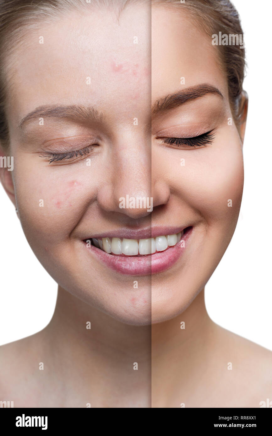 Young woman before and after skin treatment and makeup Stock Photo Alamy