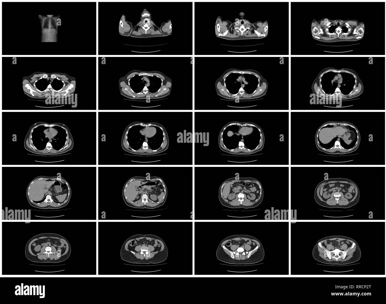 ct scan step set of upper body abdomen top view Stock Photo