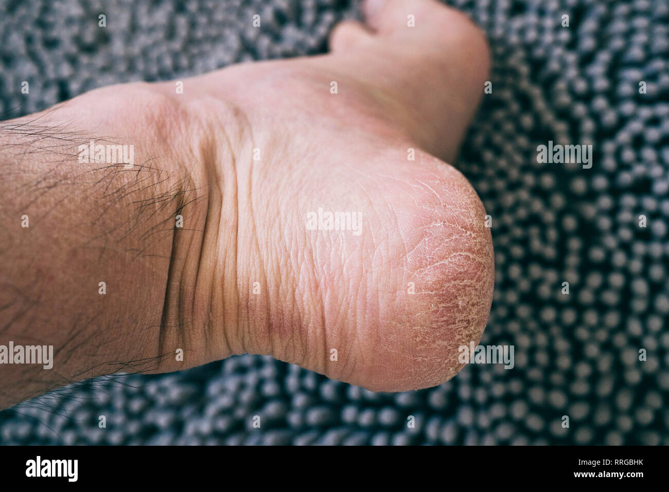 Dry and cracked skin on the heel of a Caucasian man Stock Photo