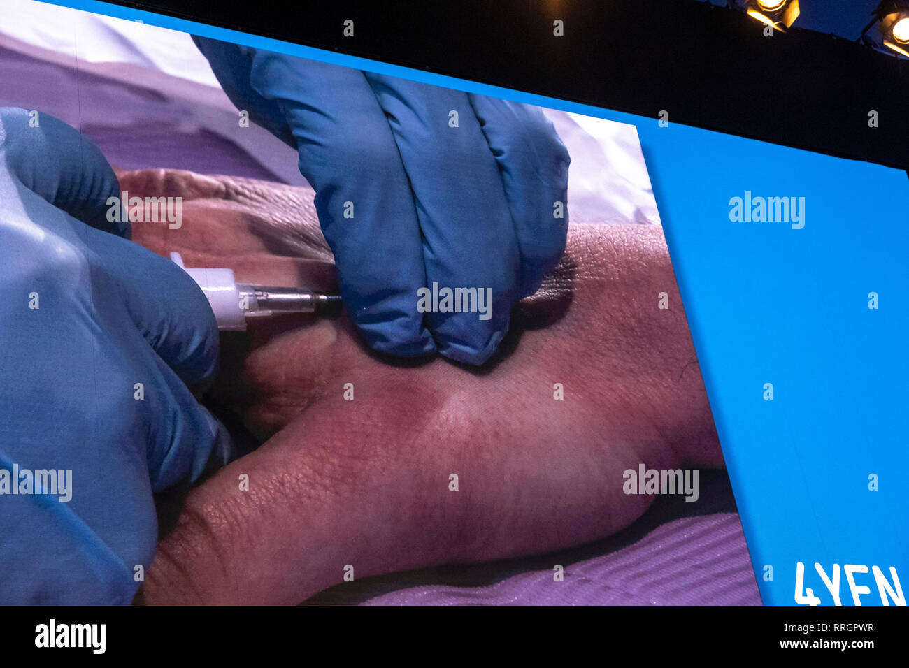 The hand of the volunteer Edgar Pons is seen during the Live Human Chip Implant Show.  Edgar Pons has been implanted with an RFID chip in his hand. Minutes later he has ordered a bank transfer using his hand as an authorization signature. In parallel to the MWC, Barcelona celebrates 4YFN Connecting Startups a fair of small business initiatives connected by technology. Stock Photo