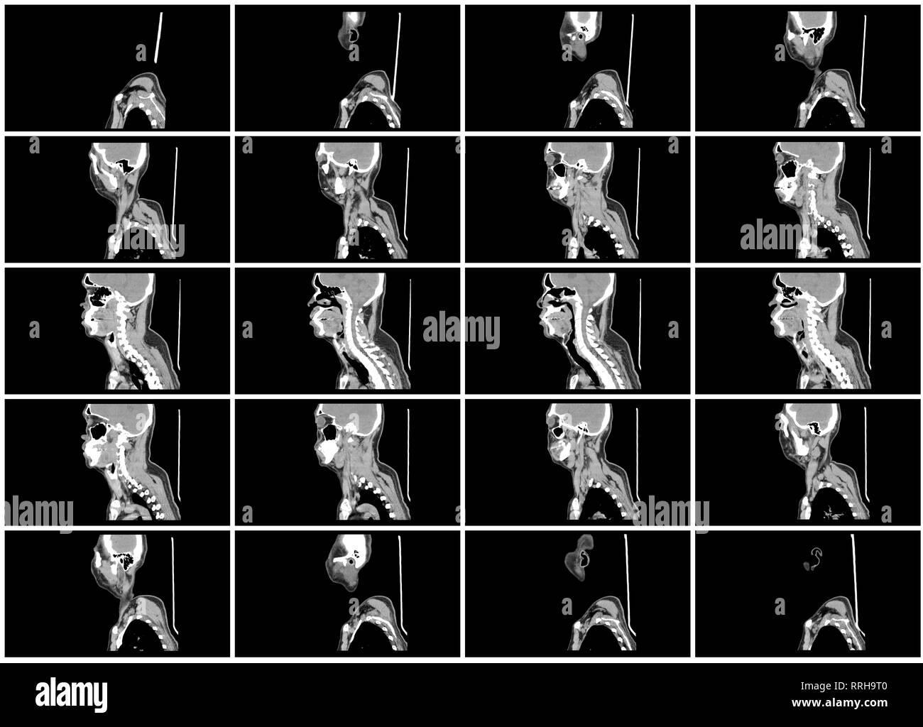 ct scan step set of neck sagittal view Stock Photo Alamy