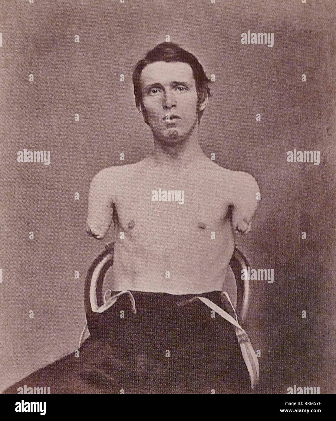Alfred A. Stratton lost both his arms at age 19 on 18 June 1864 by a cannon shot in the American Civil War. The amputation was performed by AS Coe. Stratton died as a father of two at the age of 29. Stock Photo