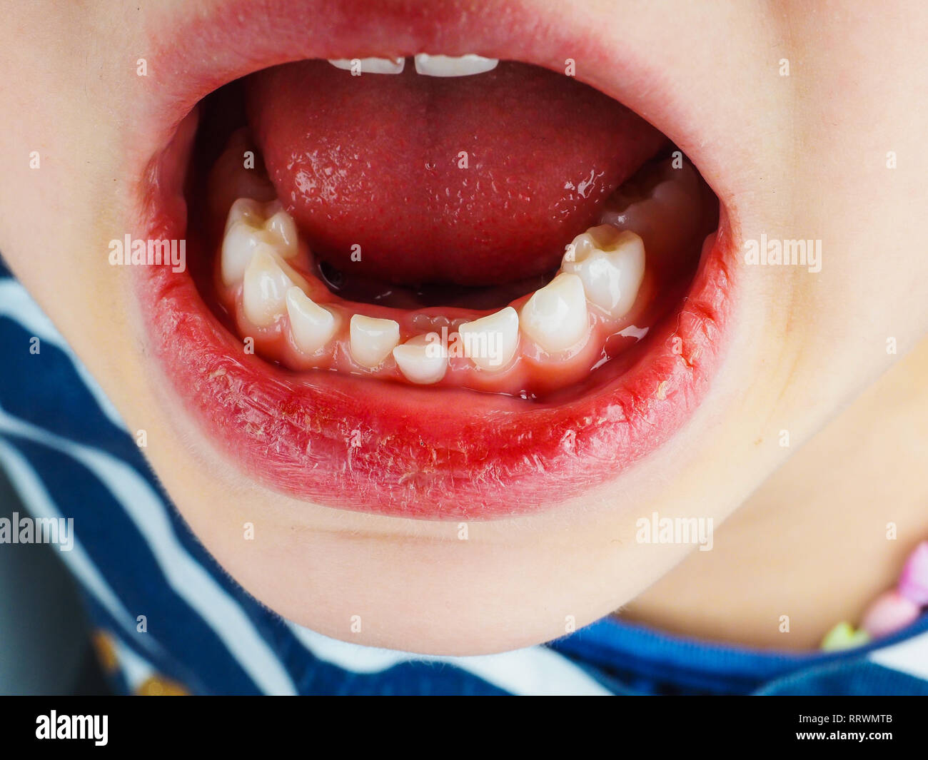 Closeup of lose deciduous tooth in a little girls mouth, bottom, front Stock Photo