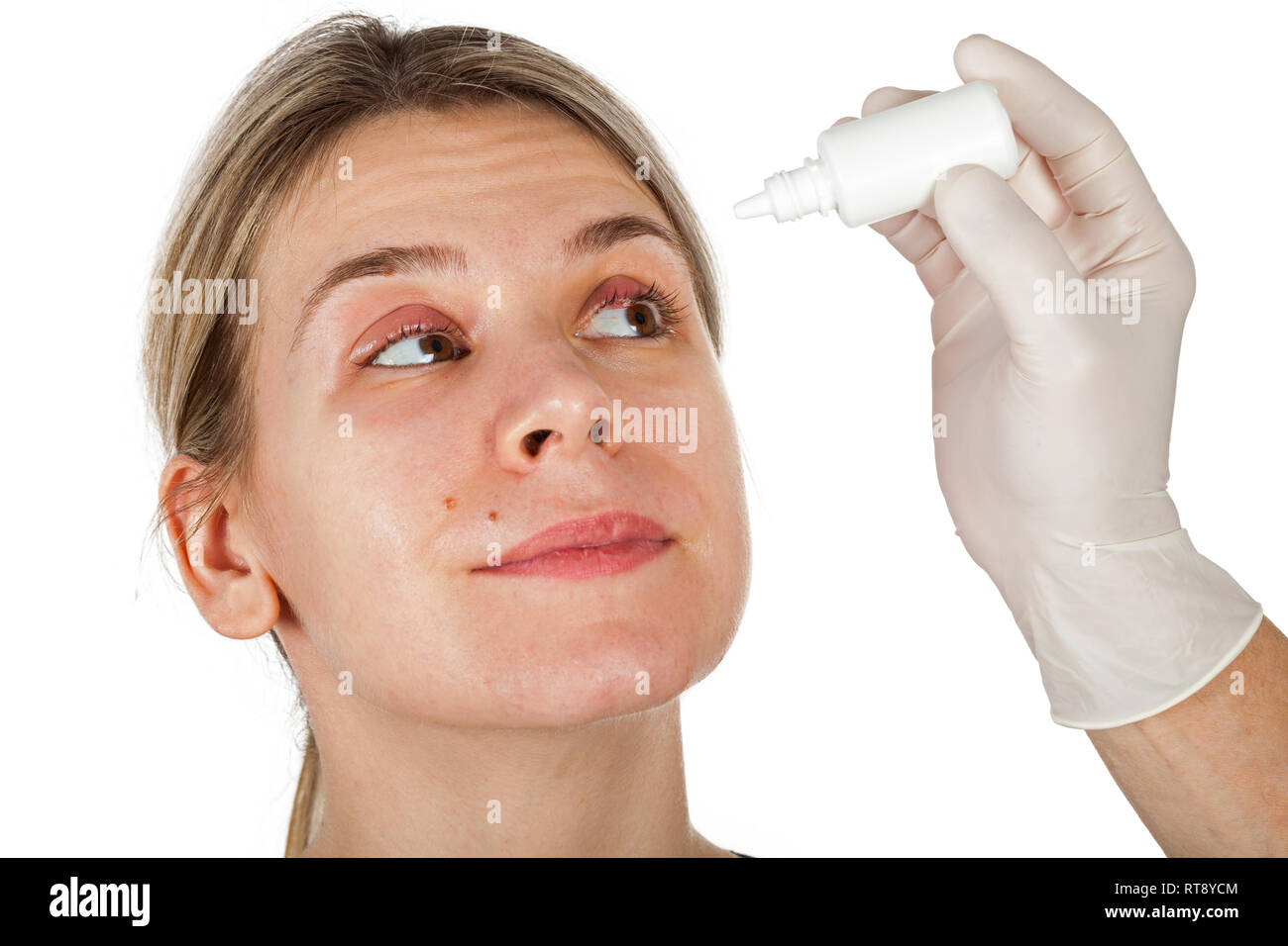 Woman with stye on upper eyelid doctor's hand holding medical eye drop on isolated background