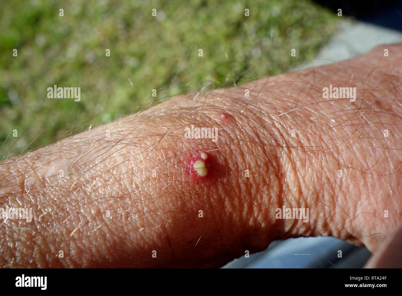 A blister from a red fire ant bite sting Stock Photo