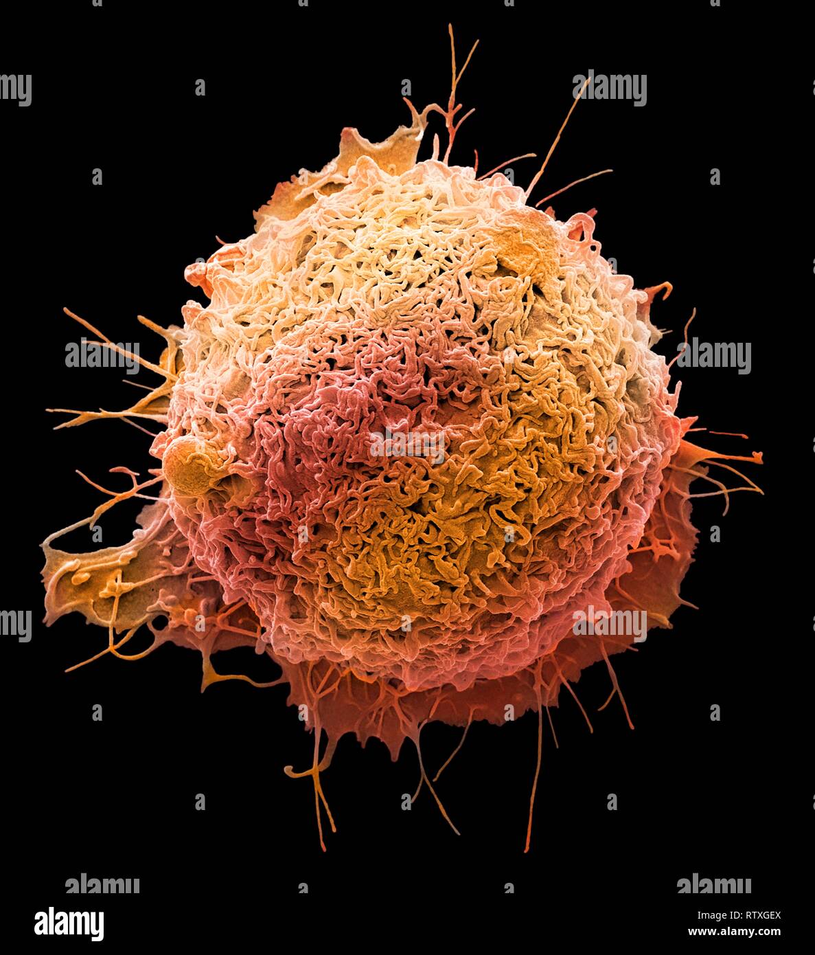 Colorectal cancer cell. Coloured scanning electron micrograph (SEM) of a cancer cell from the human colon (large intestine). Cancer of the colon is al Stock Photo