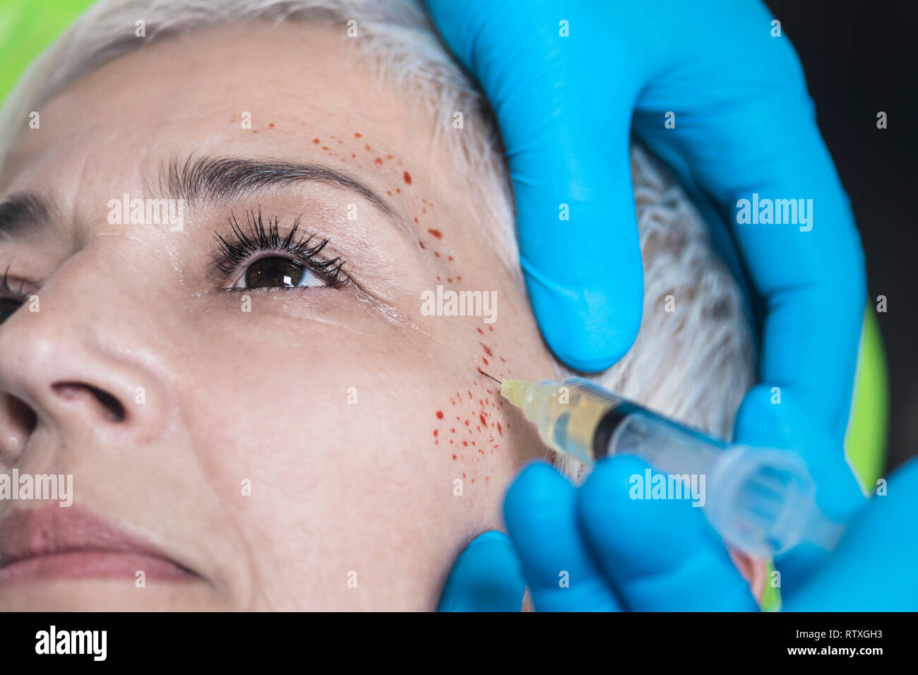 Plateletrich plasma facial treatment. Closeup of