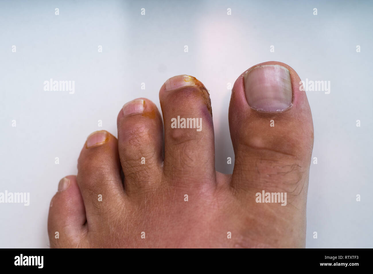 Finger on the leg. Purulent wound on the leg. Eczema. Dermatitis