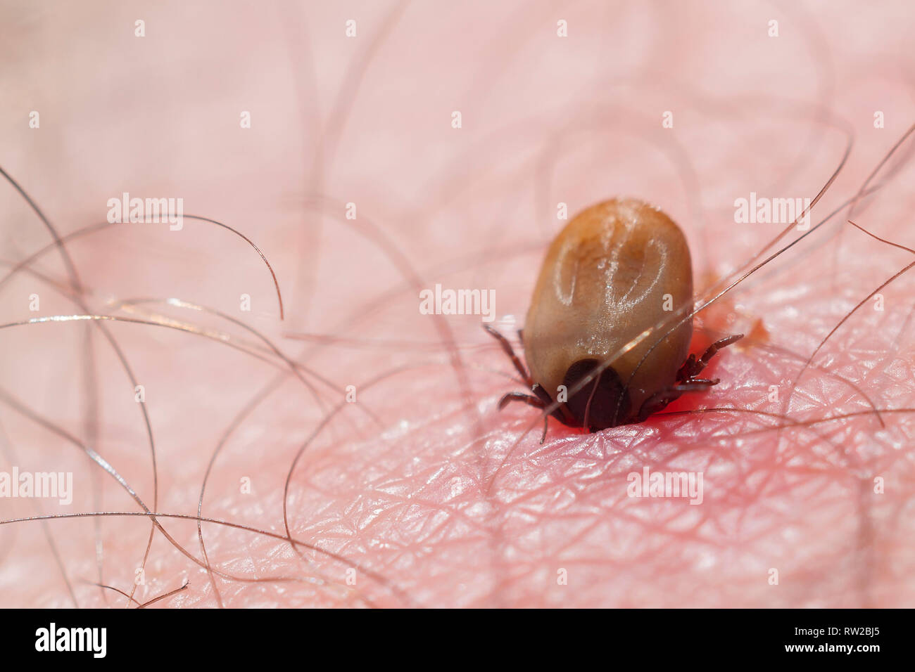 Tick on human skin: a tick while sucking blood from a human being Stock Photo