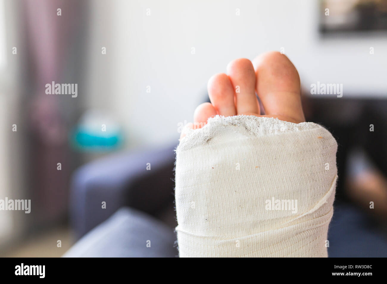 Man at home with broken leg - close up Stock Photo