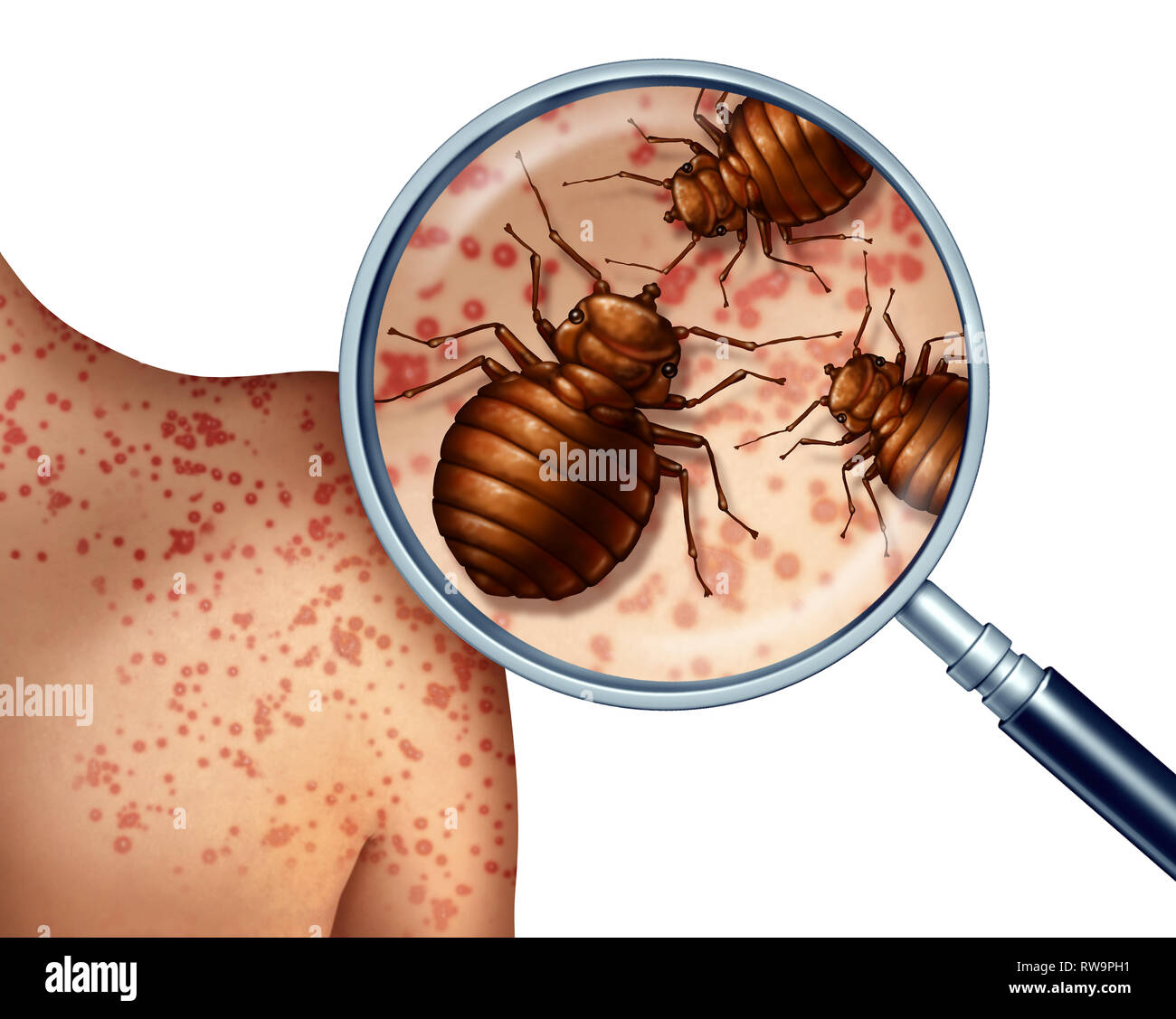 Bed bug bites on human skin  or bedbug infestation concept as a magnification close up of  parasitic insect pests as a hygiene symbol and health. Stock Photo