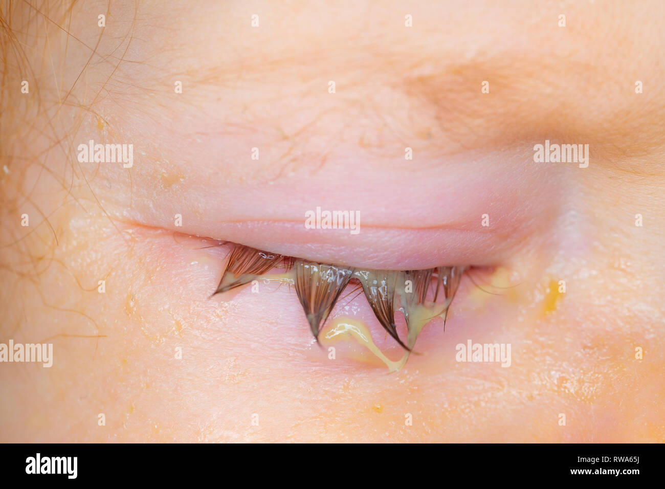 Swollen and sticky eyelid of a small baby with conjunctivitis Stock