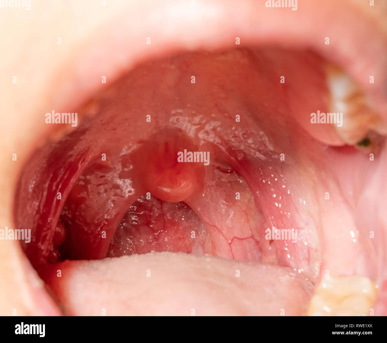 Sore throat with throat swollen. Closeup open mouth with posterior pharyngeal wall swelling and uvula and tonsil. Influenza follicles in the posterior Stock Photo