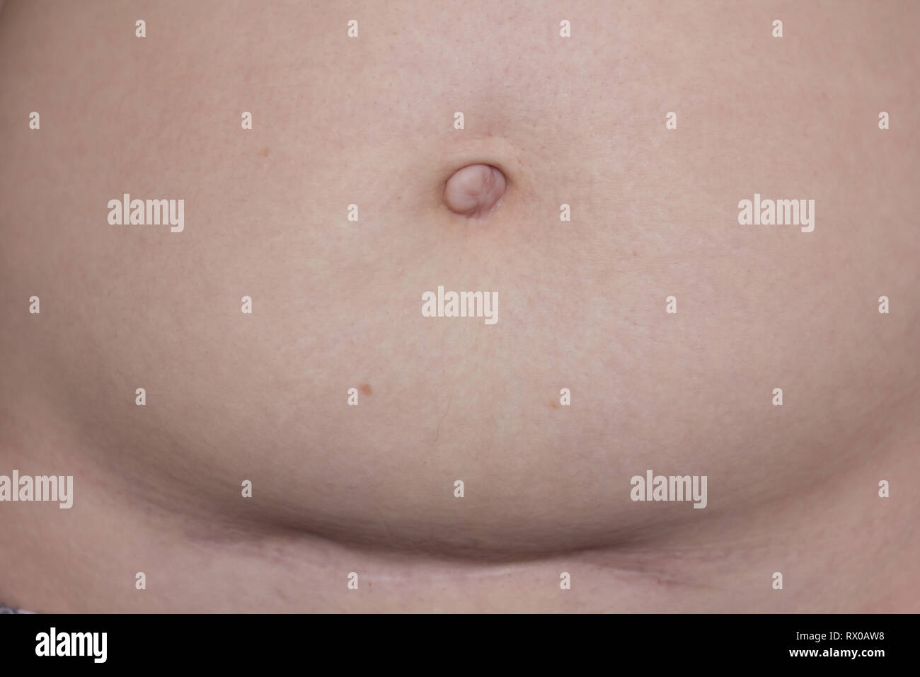 belly with a scar and stretch marks. postpartum woman's belly. ugly body. stretch marks Stock Photo