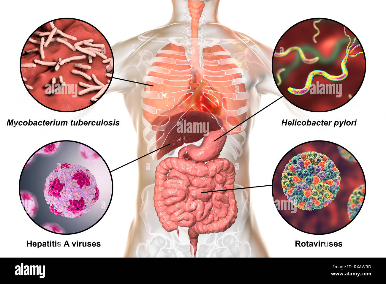 Human Is Infected Bacteria that cause human infections, illustration Stock Photo - Alamy