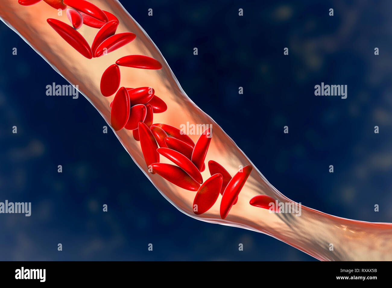 Blood vessel blocked in sickle cell anaemia, illustration Stock Photo