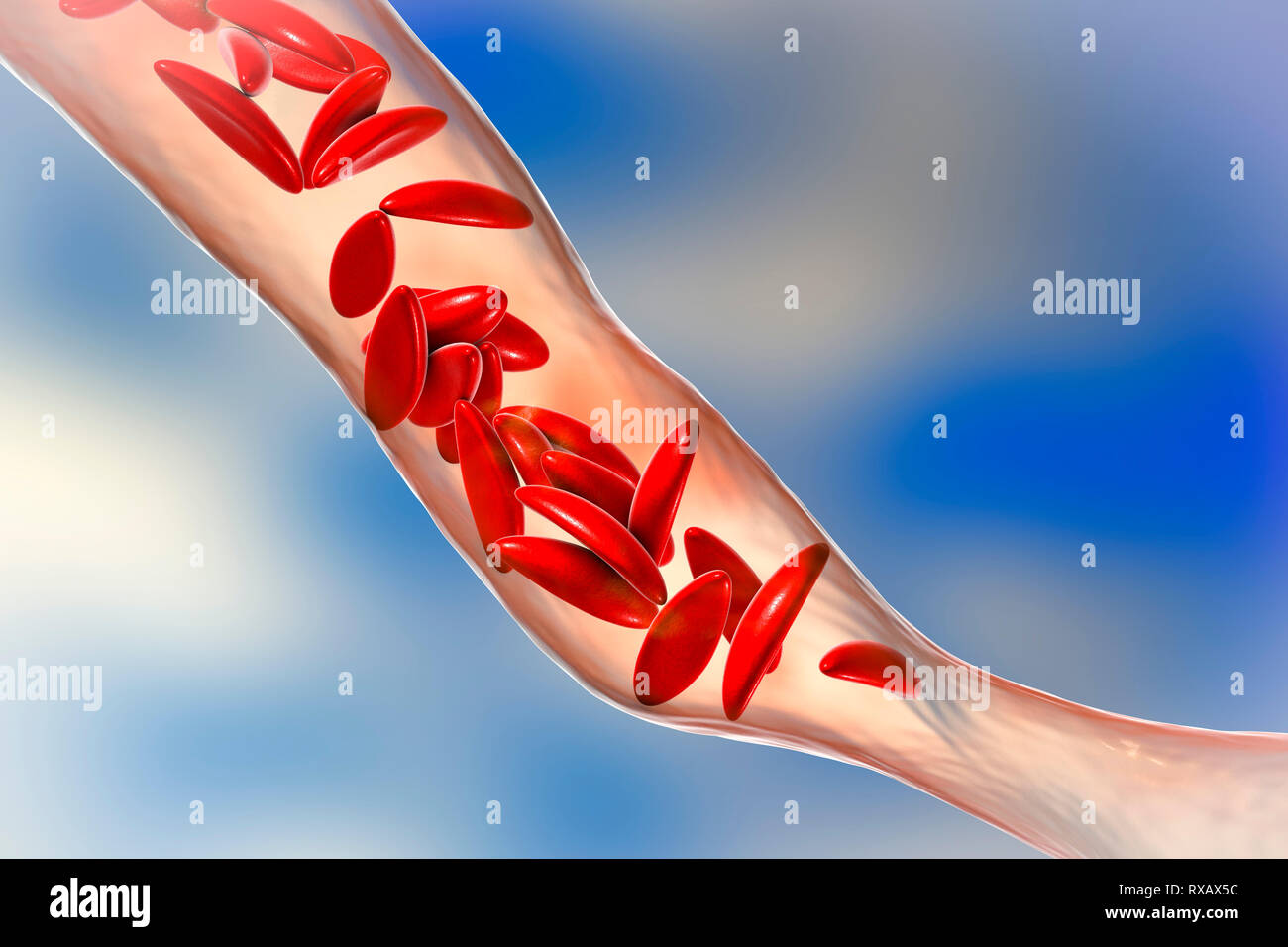 Blood vessel blocked in sickle cell anaemia, illustration Stock Photo