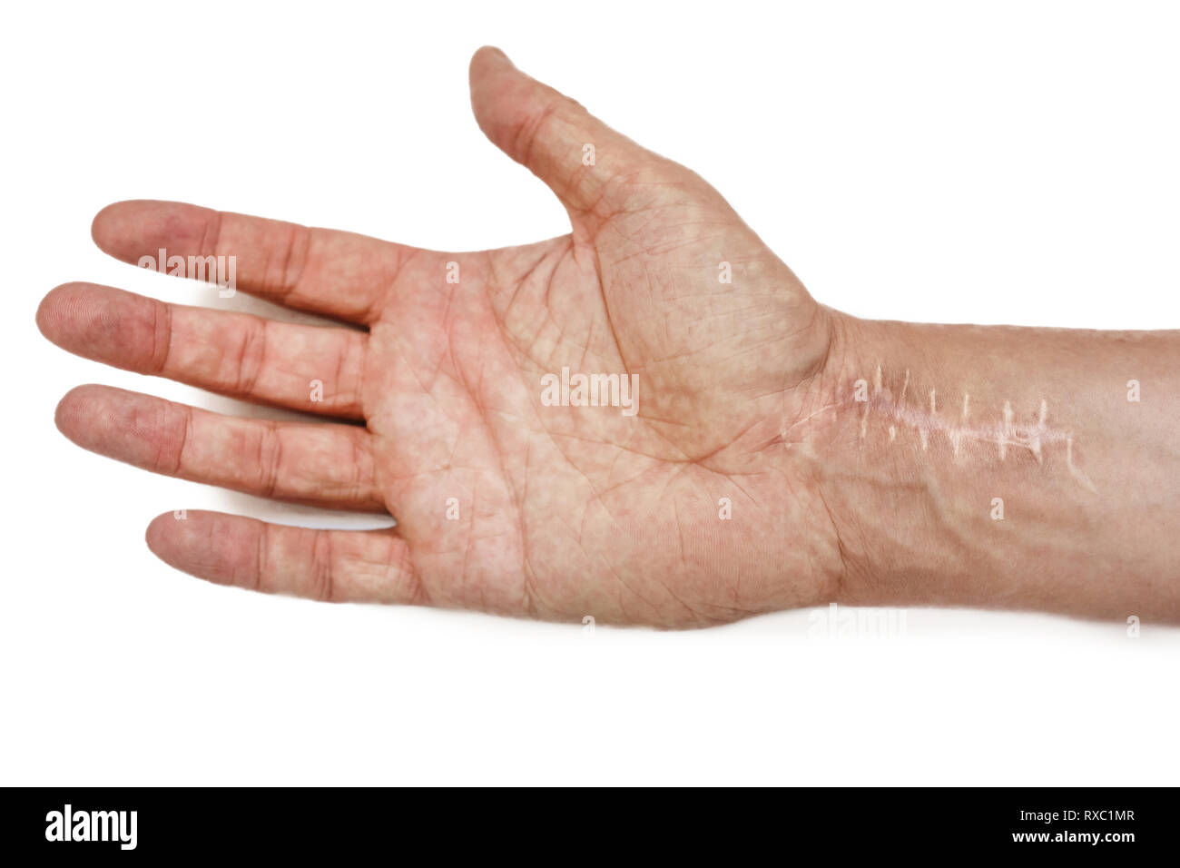 Scar with stitches on the wrist after surgery. Fracture of the bones of the hands isolated on