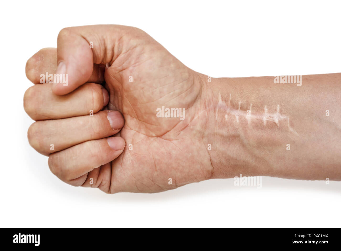 Scab Scar High Resolution Stock Photography and Images Alamy