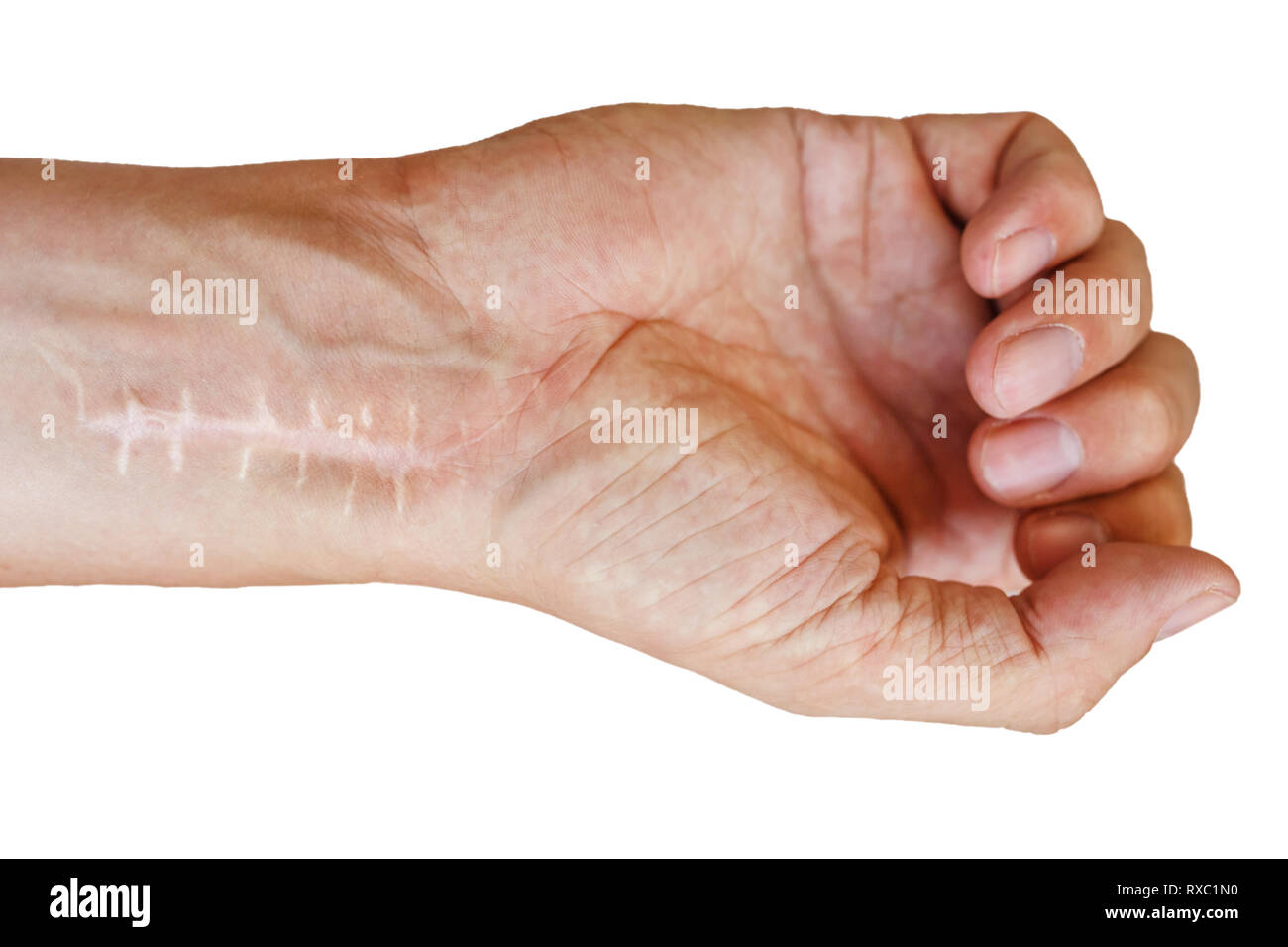 Scab Scar High Resolution Stock Photography and Images Alamy