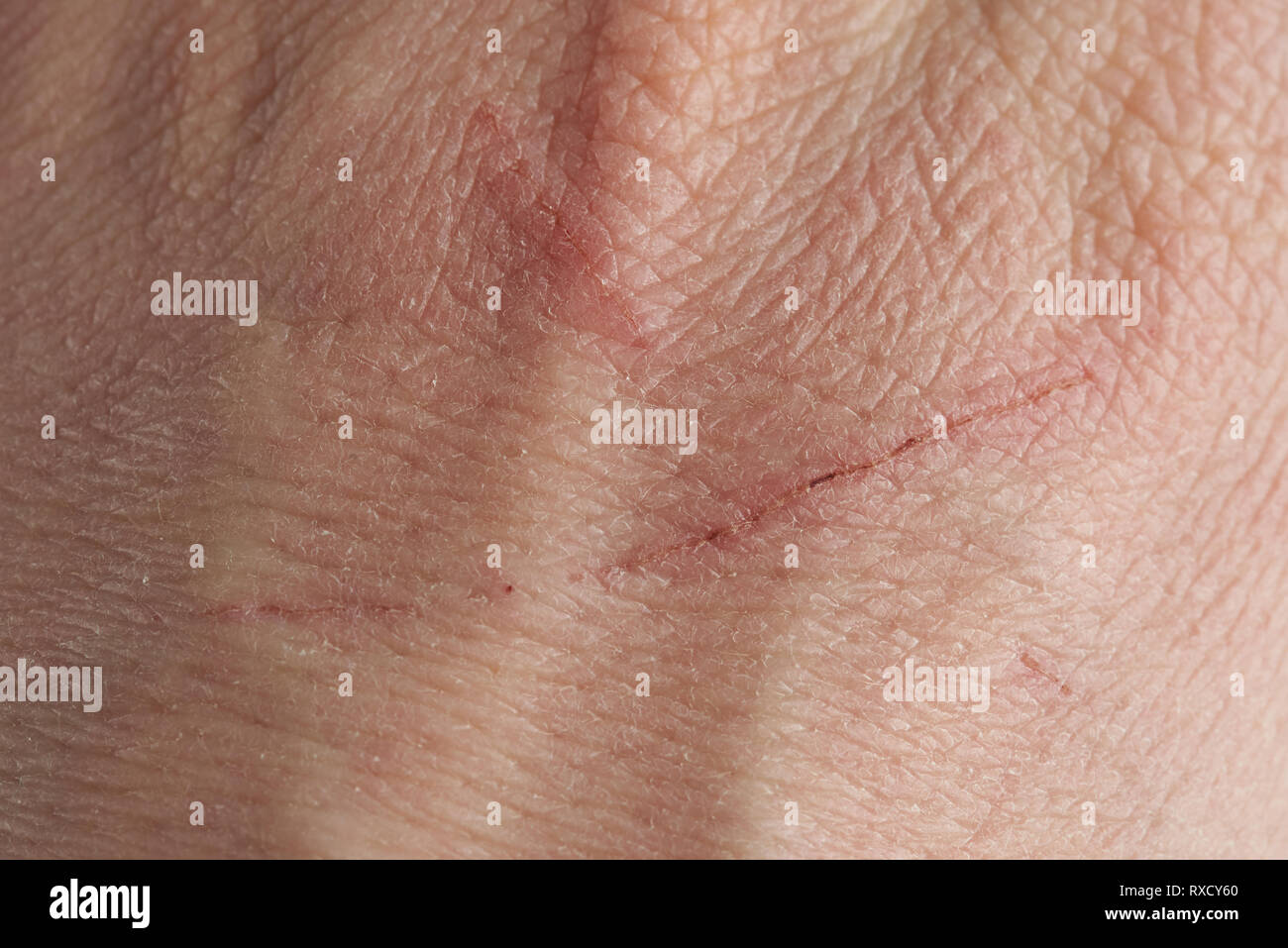 Skin with fresh scratches from cat macro  close up view Stock Photo