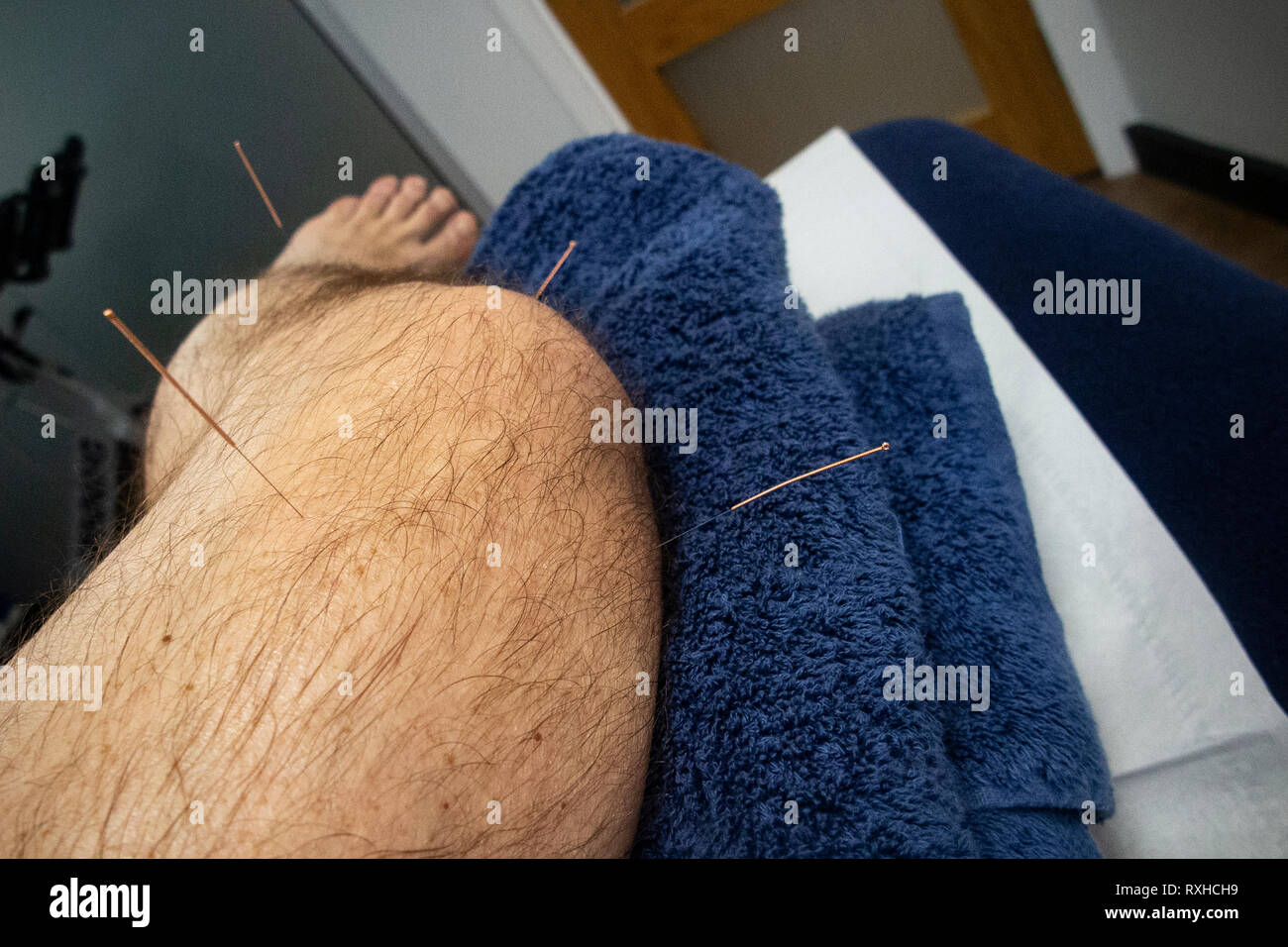 Acupuncture needles inserted in the leg of a man with an injured knee Stock Photo