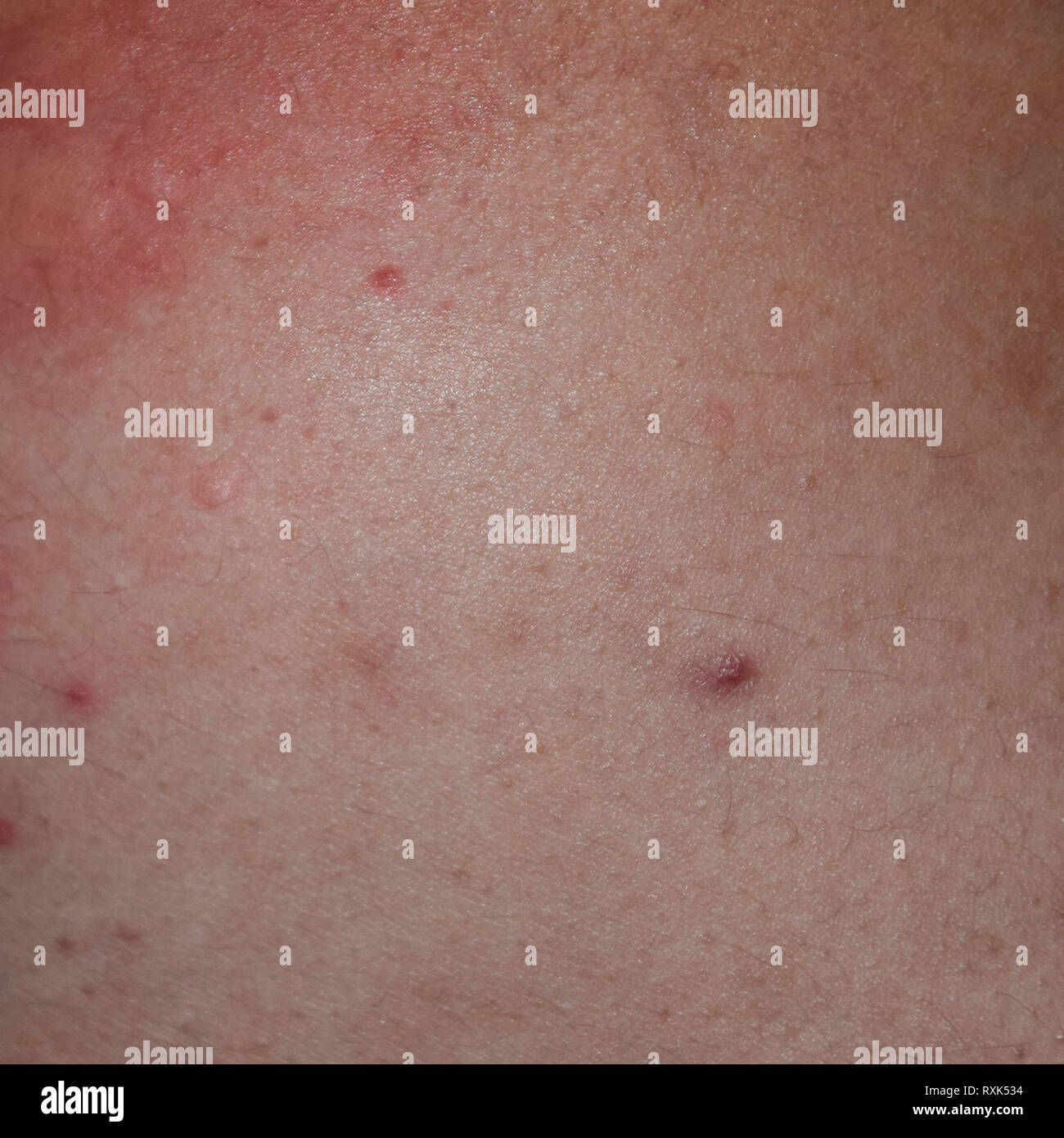 Allergy skin back and sides. Allergic reactions on the skin in the form