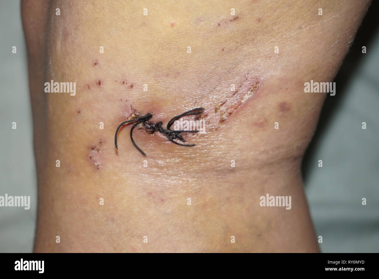 stitched wound Stock Photo