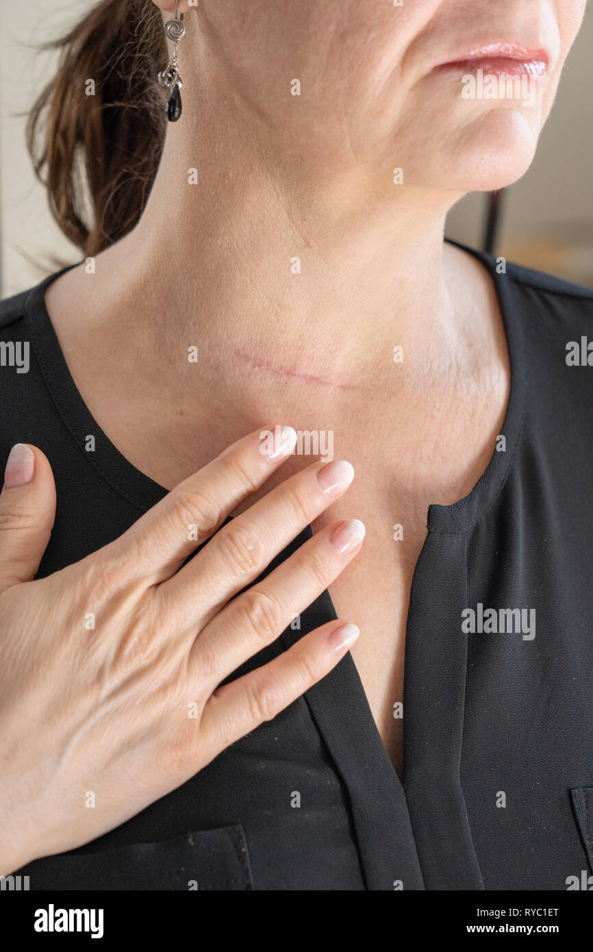 a 53 year old woman touches a scar on her neck Stock Photo
