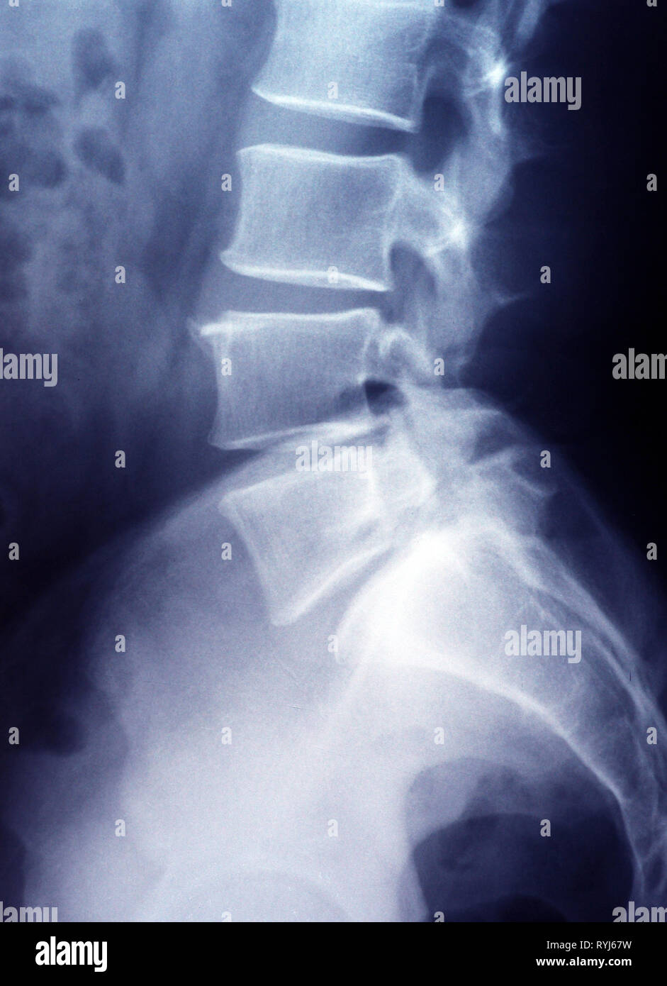 Lumbar spine x-ray film lower thorax Stock Photo