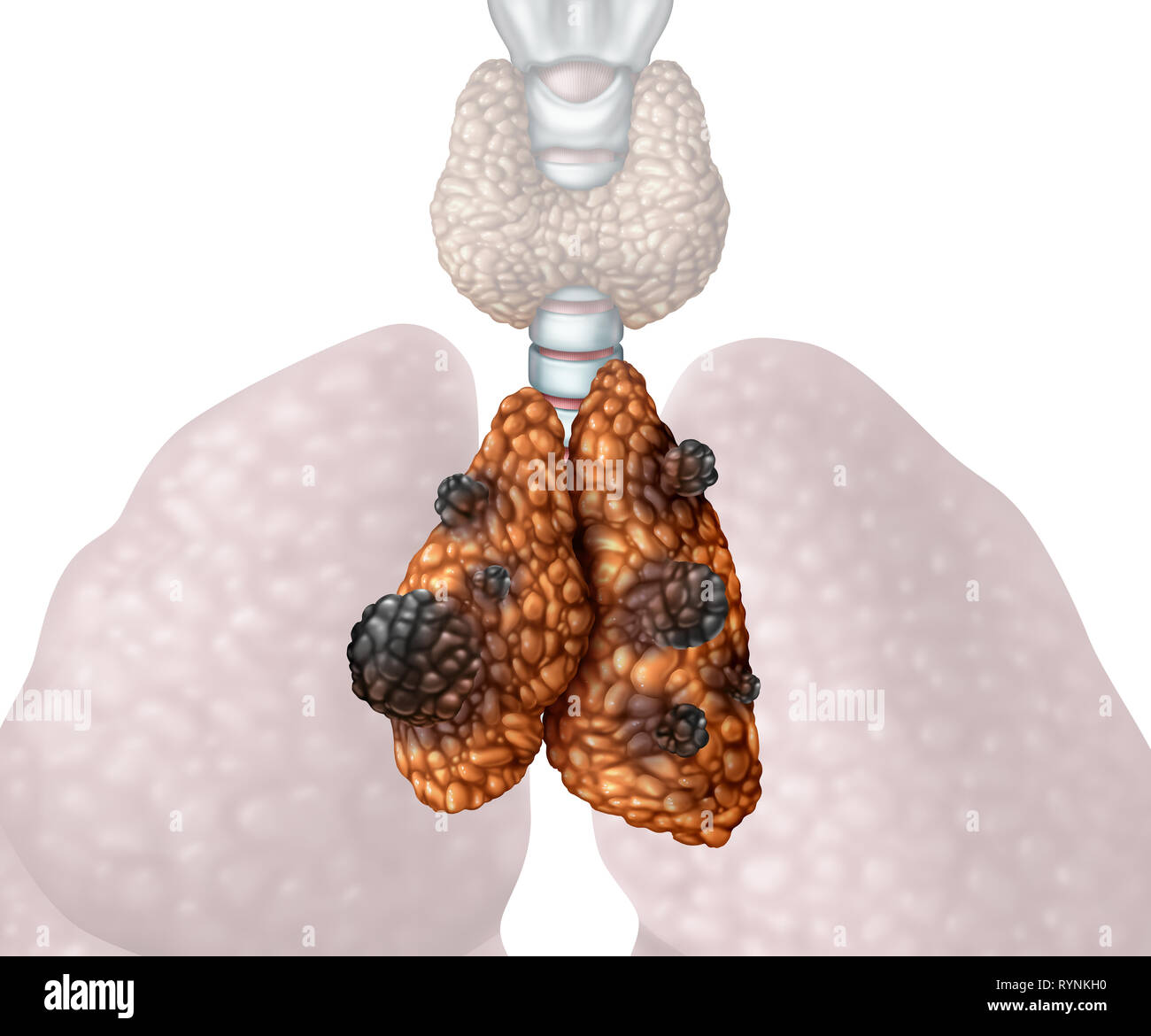 Thymus cancer or thymoma and thymic carcinoma disease as a gland anatomy illness with growing malignant mutating cell growth as an icon isolated. Stock Photo
