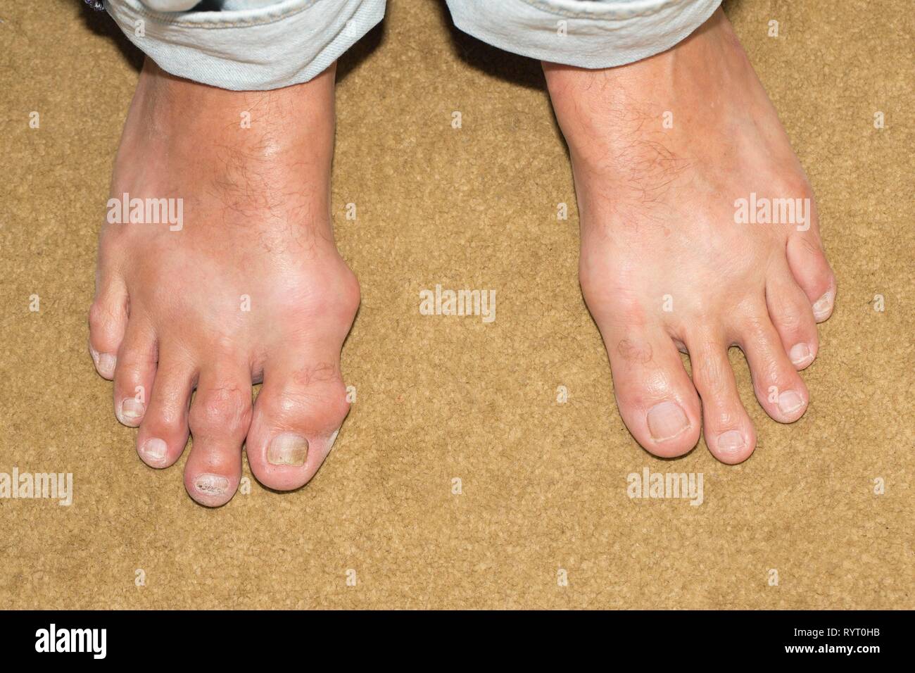 Male foot with gout, Germany Stock Photo