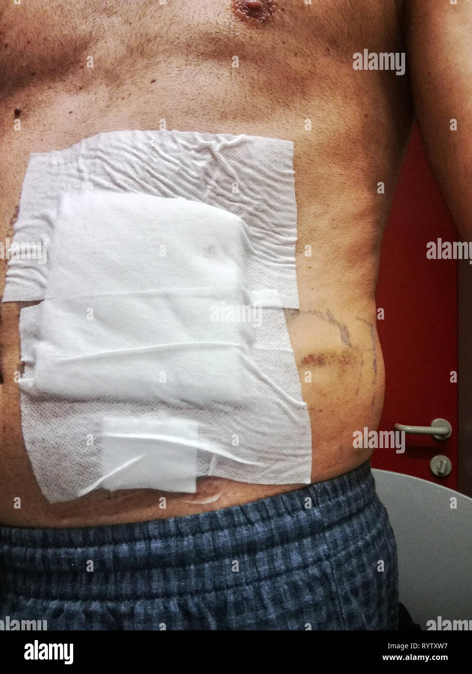 Colostomy stoma hires stock photography and images Alamy Colostomy stoma hires stock photography and images Alamy