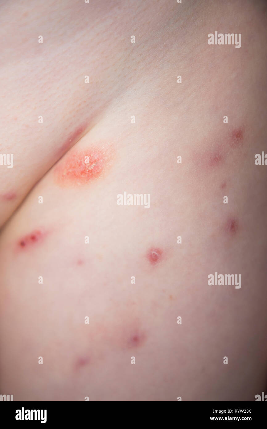 The Body Of A Six Year Old Girl With Molluscum Contagiosum Spots A Common And Generally Harmless Condition That Causes Spot Rash On Skin It Is Most Common In Children Young Adults Stock