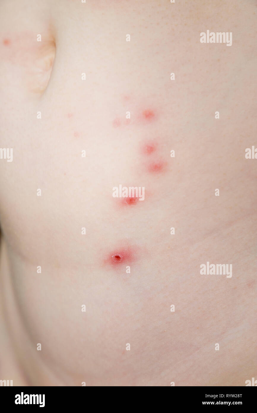 The body of a sixyearold girl with Molluscum contagiosum spots; a